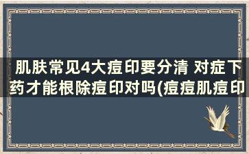 肌肤常见4大痘印要分清 对症下药才能根除痘印对吗(痘痘肌痘印用什么护肤品)